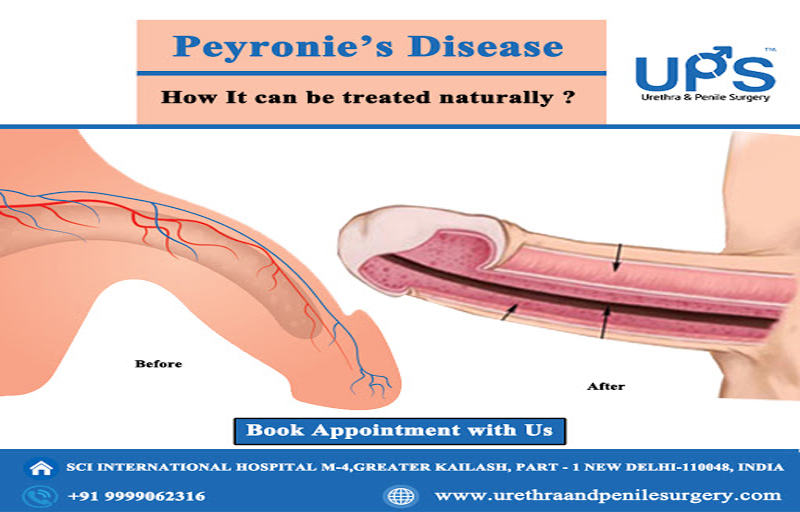 Peyronie disease treatment in delhi