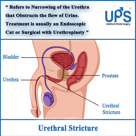 Urethra & Penile Surgery